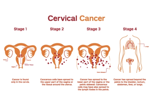 Stages of Breast Cancer