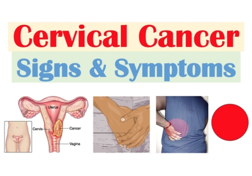 Symptoms of Cervical Cancer