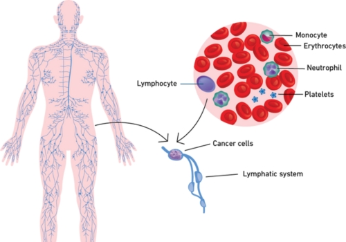 Lymphoma