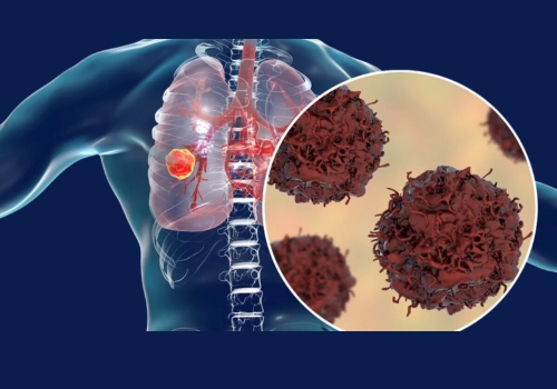 Thoracic Cancer - Lungs