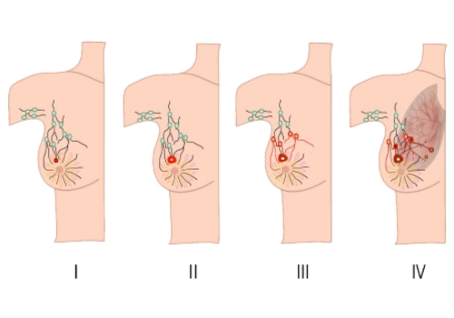 Stages of Breast Cancer