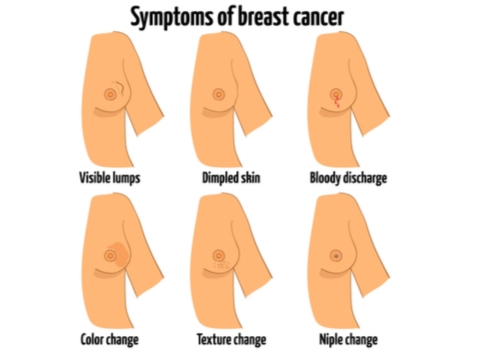 Symptoms of Breast Cancer