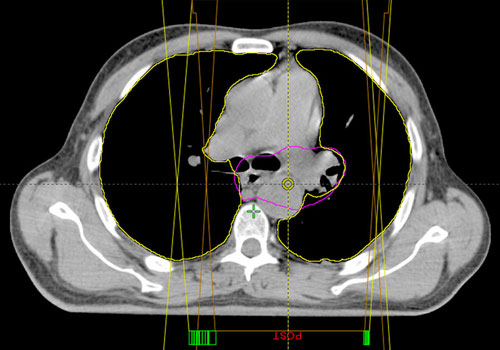 3-Dimensional Conformal Radiotherapy